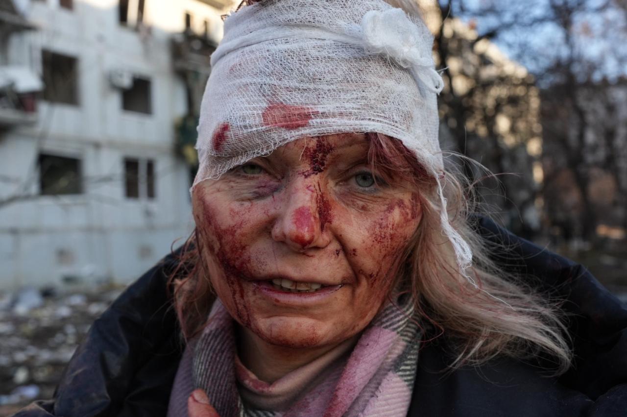 La mujer herida en la foto después del ataque aéreo en Chuguiv cerca de Karkhiv