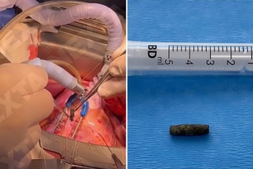 Los cirujanos eligen una bala del CORAZÓN LATENTE de un soldado ucraniano en una operación increíble