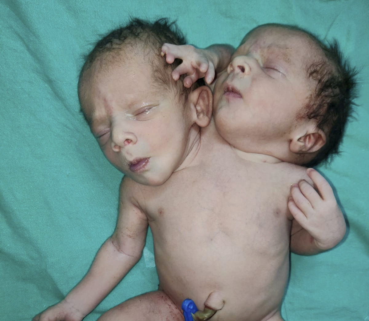 Nace un niño con dos cabezas, tres manos y dos corazones en Madhya Prades, India
